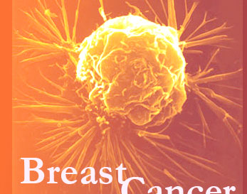 خطر سرطان سینه در چه افرادی بالا است؟