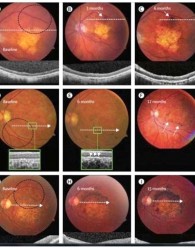 درمان کوری چشم با سلول‌های بنیادی