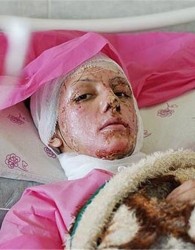 آخرین وضع قربانیان اسید پاشی در اصفهان