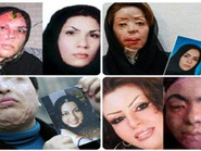 قربانیان اسیدپاشی اصفهان پس از سه ماه