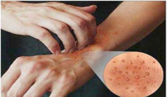 فست فود؛ عاملی برای اگزمای پوست