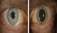 ابولا رنگ چشم را تغییر می‌دهد/عکس