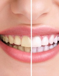 روش‎‎های پیشگیری از پوسيدگي دندان‌ها