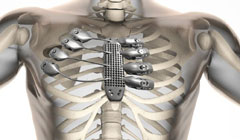 چاپ سه‌بعدی دنده و جناغ سینه برای یک بیمار