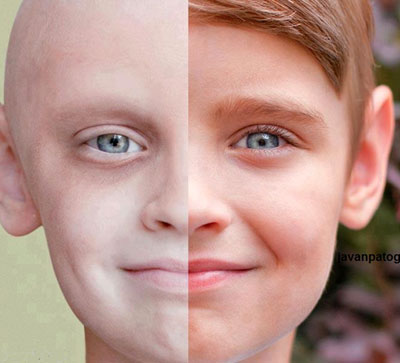 سرطان خون‌ شایع ترین سرطان بین کودکان