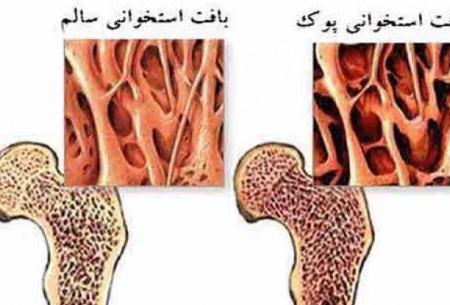 پوکی استخوان بیماری بی صدا