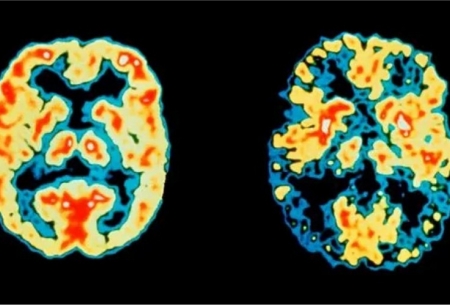 تشخیص آلزایمر7‌سال قبل از اولین علائم