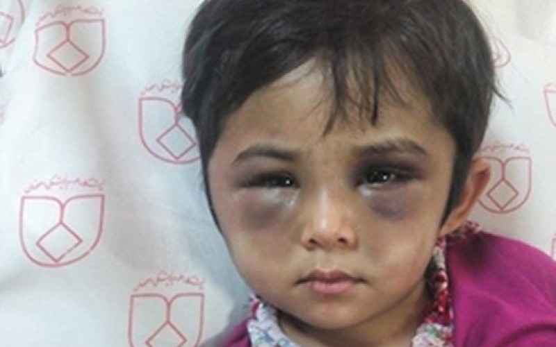 کودک آزار دیده با صورت کبود/عکس