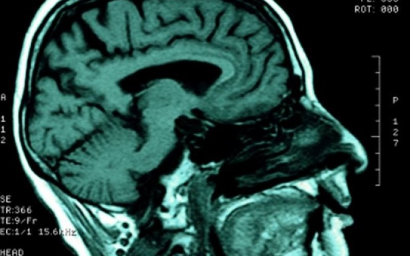 بافت آسیب دیده مغز پس از سکته سمی می شود