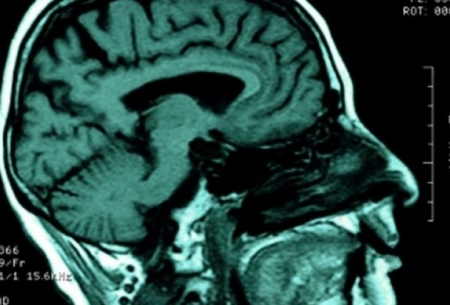 بافت آسیب دیده مغز پس از سکته سمی می شود