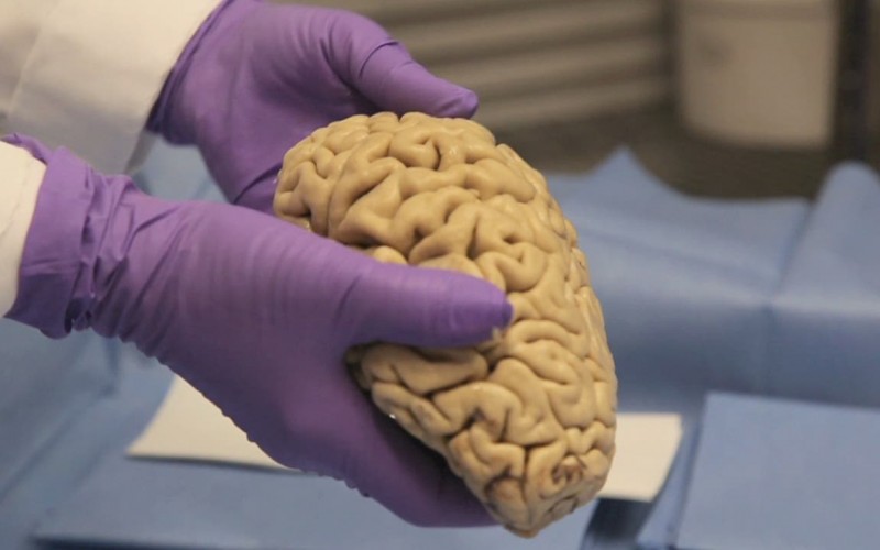 بانک مغز روزنه‌ای به سوی بیماران سیستم عصبی