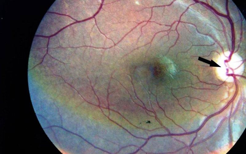 کشف یک چربی در پیشگیری به بیماری چشم