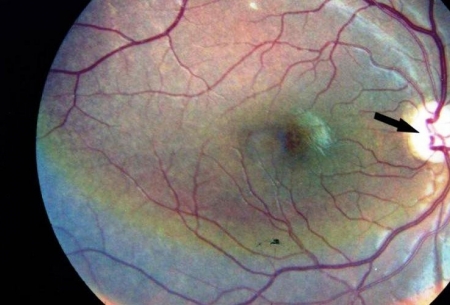 کشف یک چربی در پیشگیری به بیماری چشم