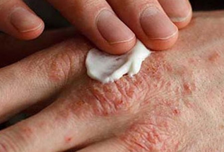 راهکارهای درمانی اگزمای پوست