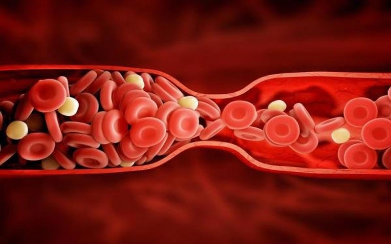 عوامل تاثیرگذار بر افزایش خطر لخته شدن خون