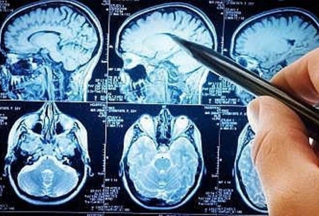آمبولی شایعترین علت سکته های مغزی است