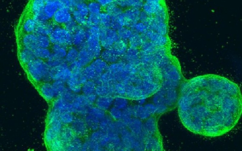 مکانیزم مخفی شدن سلول‌های سرطان سینه