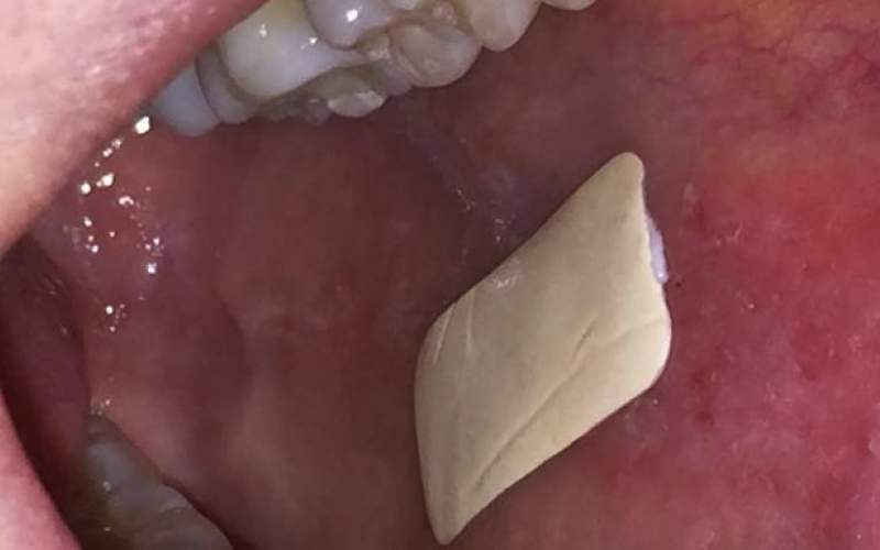 ابداع پچ برای درمان زخم‌های داخل دهان