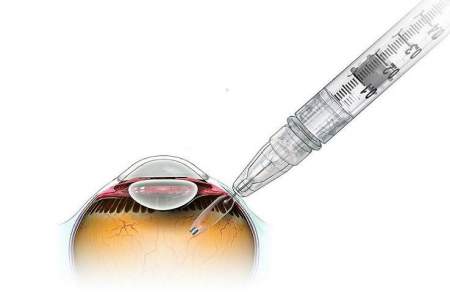جلوگیری از نابینایی بااستفاده از ایمپلنت چشمی