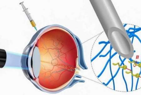 دارورسانی مستقیم از چشم توسط ربات‌