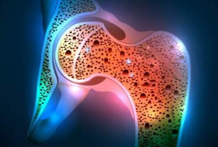 شناسایی راهی جدید برای درمان پوکی استخوان