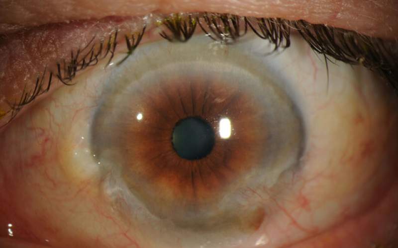 تشخیص بیماری چشمی با هوش مصنوعی