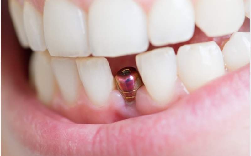 انواع و روش‌های ایمپلنت دندان