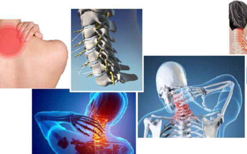 علت رادیکولوپاتی گردن (تحت فشار قرار گرفتن عصب) و راه های درمان