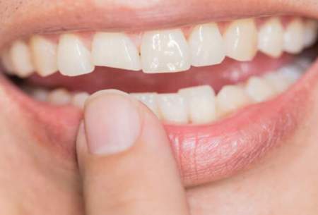 ترمیم دندان‌ها با سلول‌های بنیادی