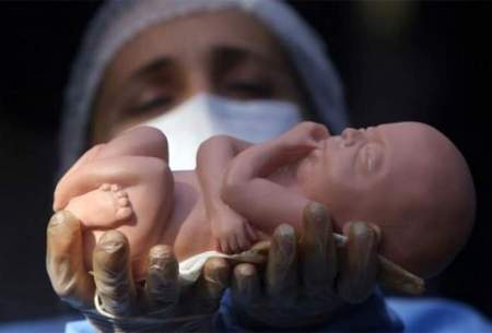 سالیانه؛ ۳۰۰ تا ۵۰۰هزار سقط جنین در ایران