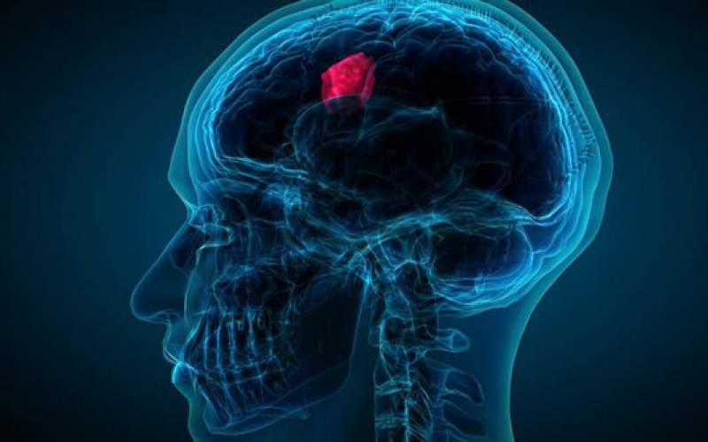 تشخیص تومور مغزی تهاجمی با یک آزمایش ساده