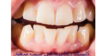 اصلاح و درمان  دندان‌های کج