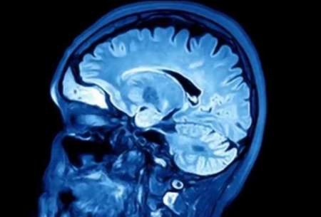 آسیب مغزی عامل زوال عقل در برخی میانسالان
