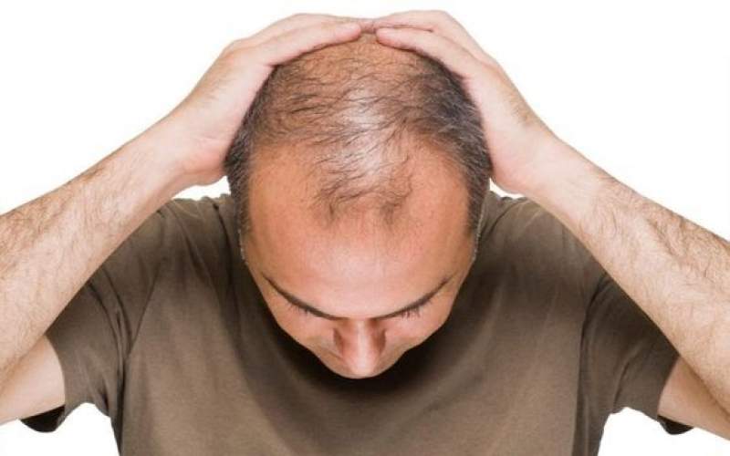 مواردی که پیش از کاشت مو و عمل لیپوساکشن باید بدانید