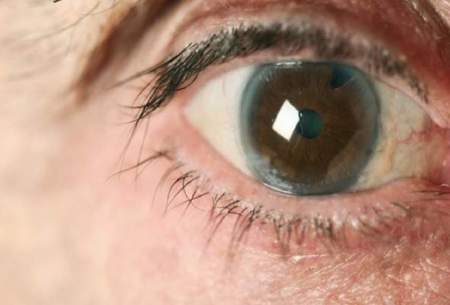عارضه چشمی که در جوانی خطرآفرین است
