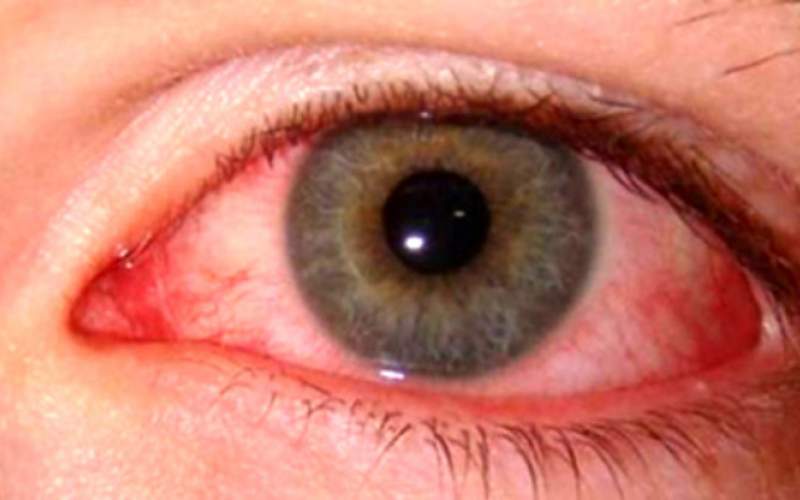 عارضه چشم صورتی نشانه ویروس کروناست
