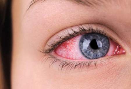 علت و درمان‌های ساده برای قرمزی چشم