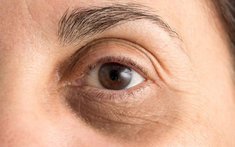 چه عواملی باعث ایجاد سیاهی زیر چشم می‌شوند؟
