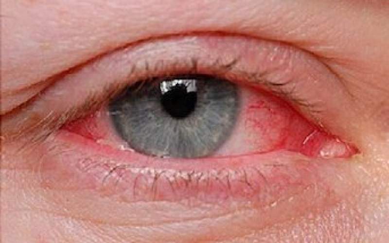 مراقب شایع‌ترین بیماری چشم در فصل گرما باشید