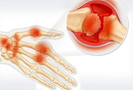 نانوذرات ورم مفاصل روماتیسم را کم می‌کند