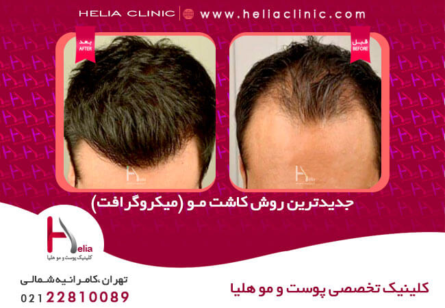 کاشت مو چیست و هزینه آن چقدر است بهار نیوز