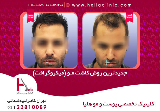 کاشت مو چیست و هزینه آن چقدر است بهار نیوز
