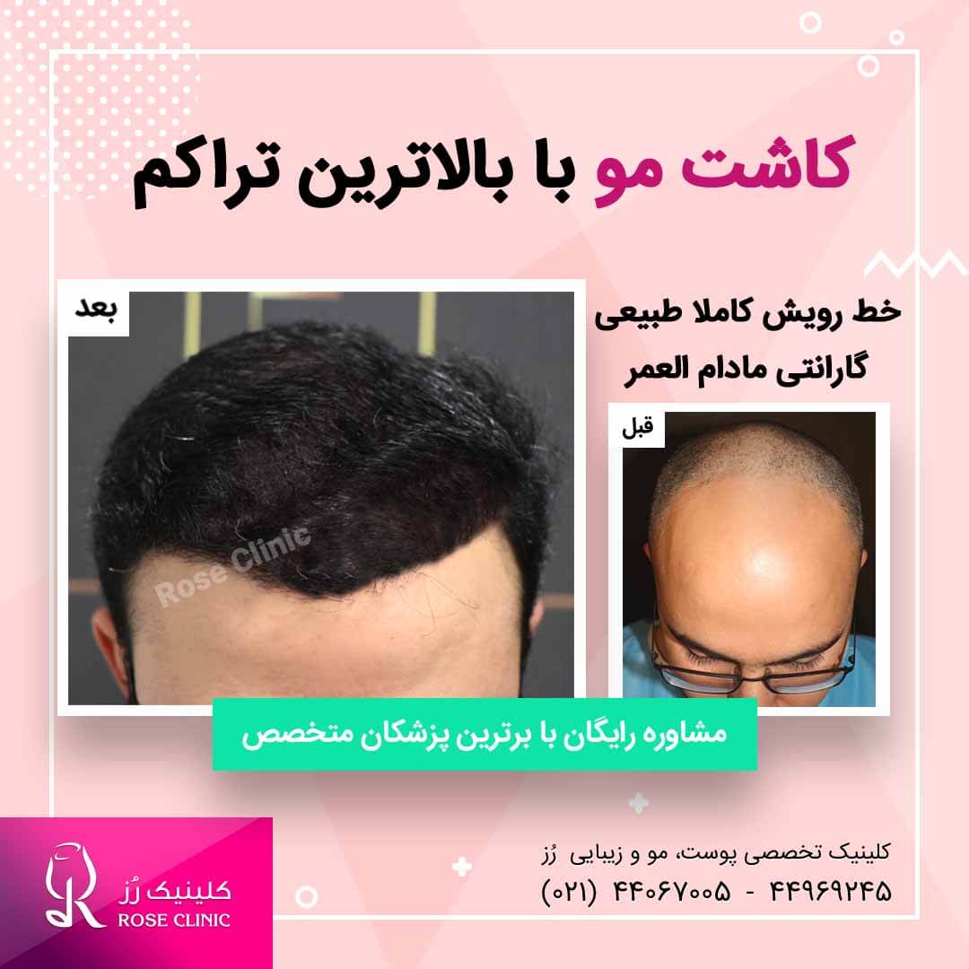 هزینه کاشت مو و ابرو در کلینیک رز بهار نیوز