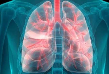 سرطان ریه را 12 سال زودتر تشخیص دهید