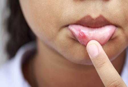 ترفند‌های خانگی برای درمان آفت دهان