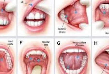 سرطان های دهان، جزء ۱۰ سرطان شایع بدن