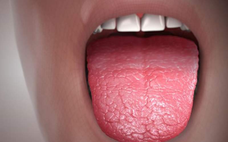 آنچه از خشکی دهان باید بدانید