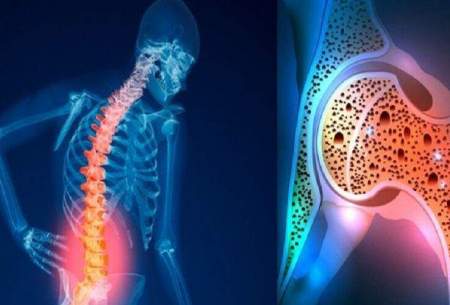 میزان بروز پوکی استخوان بیشتر از سایر بیماری‌های غیرواگیر است