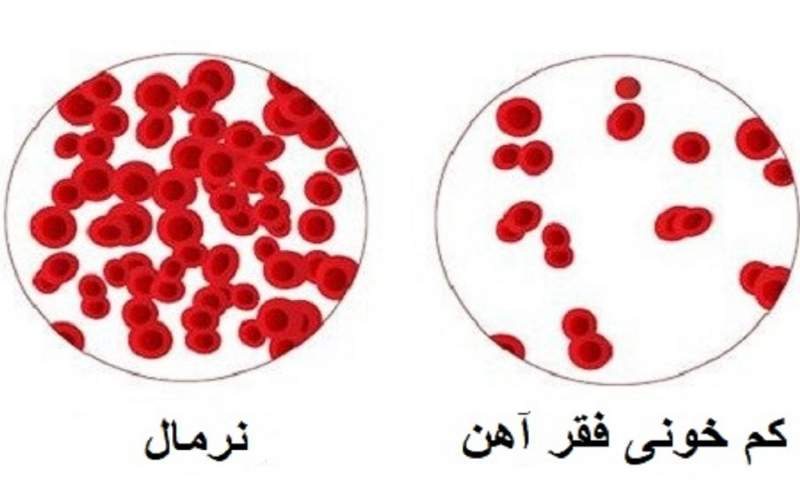 شایع ترین علائم کم خونی را بشناسید