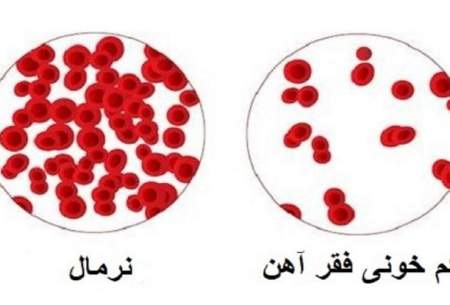 شایع ترین علائم کم خونی را بشناسید